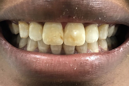 After Fixed Metal Braces at iDental London