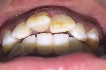 Before Fixed Metal Braces at iDental London