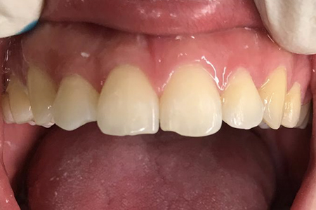 After Traditional Metal Braces at iDental