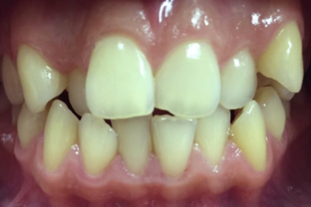 Before Traditional Metal Braces at iDental